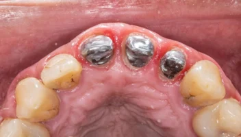 Anterior post and core crowns
