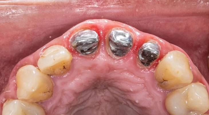 Anterior post and core crowns