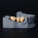 Dental Bridge Design and Procedure