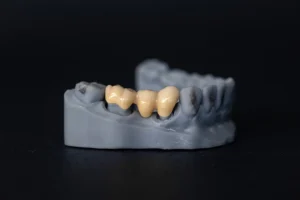 Dental Bridge Design and Procedure