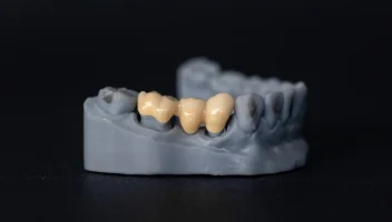 Dental Bridge Design and Procedure
