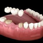 Fixed Dental Bridges