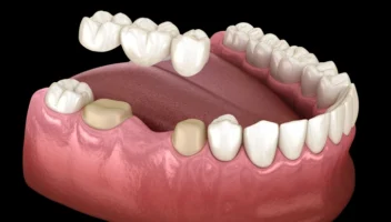 Fixed Dental Bridges