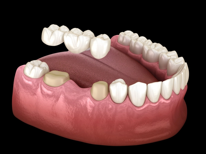 Fixed Dental Bridges