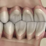 Occlusion in Restorative Dentistry