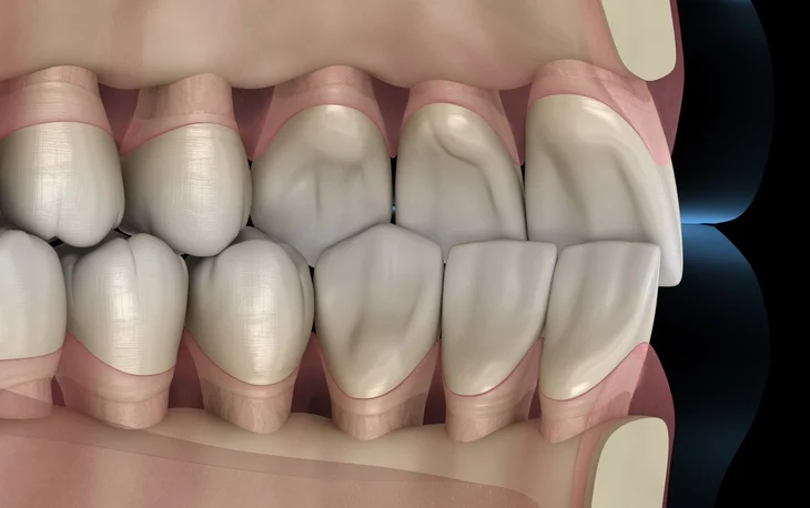 Occlusion in Restorative Dentistry