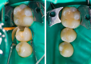 Posterior Composite Restorations