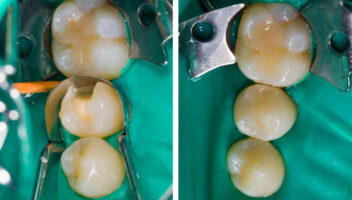Posterior Composite Restorations