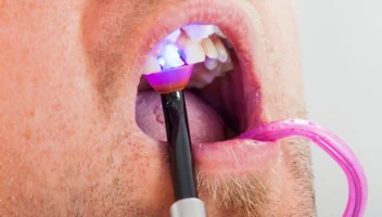 anterior proximal caries