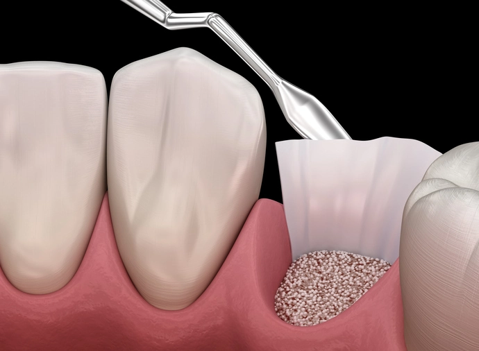 periodontal regeneration