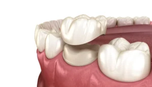 posterior crowns