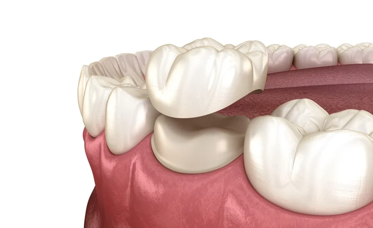 posterior crowns