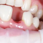 treatment planning for missing teeth