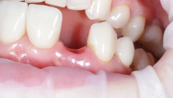 treatment planning for missing teeth