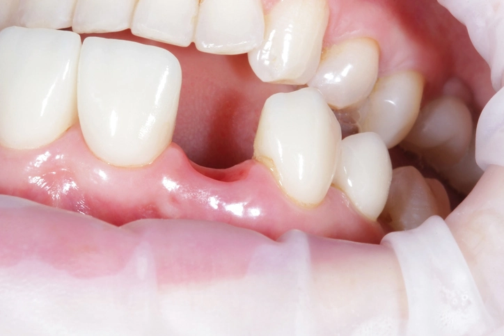 treatment planning for missing teeth