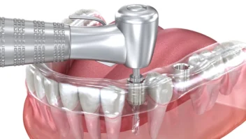 Dental implant placement