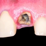 Removal of Retained Roots