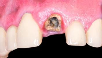 Removal of Retained Roots