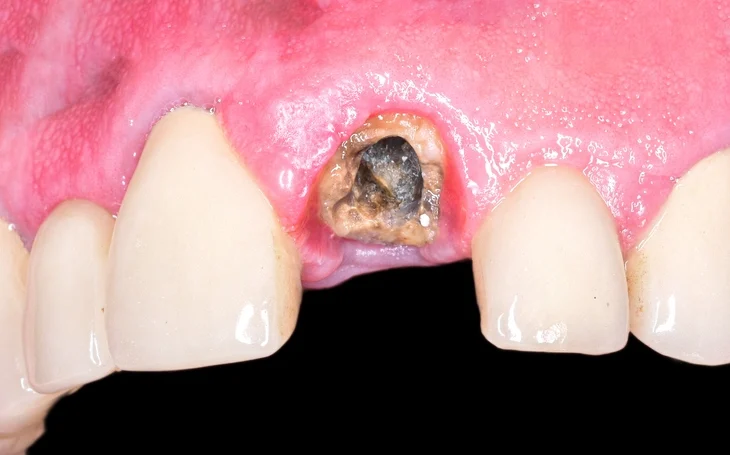 Removal of Retained Roots