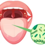 Bacterial Infections of the Mouth