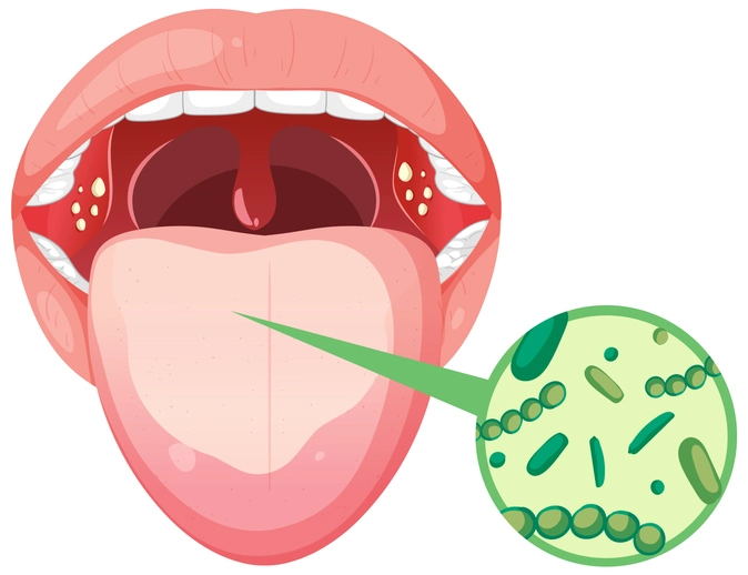 Bacterial Infections of the Mouth