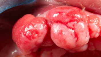 Benign Tumours of the Mouth