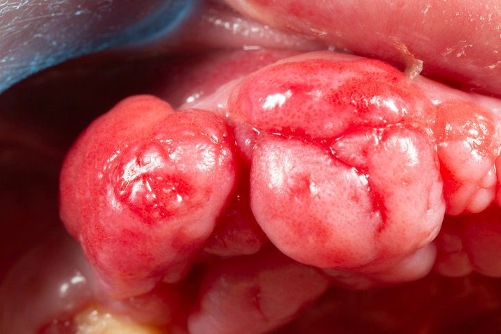 Benign Tumours of the Mouth