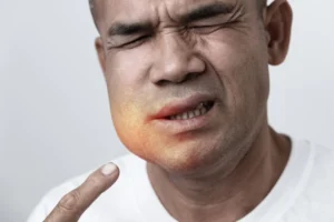 Dento-Facial Infections