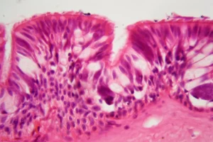 Intraepithelial Vesiculo-Bullous Disorders