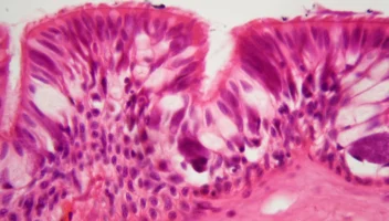 Intraepithelial Vesiculo-Bullous Disorders