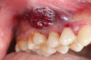 Non-tumour soft tissue lumps in the mouth
