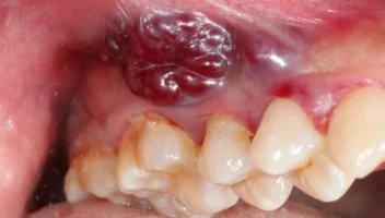 Non-tumour soft tissue lumps in the mouth