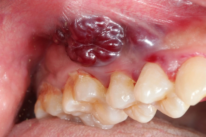Non-tumour soft tissue lumps in the mouth