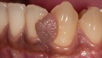 Pigmented Lesions of the Mouth