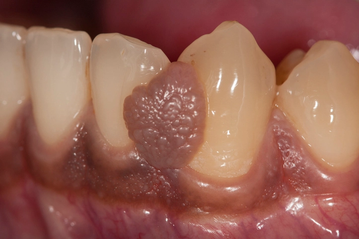 Pigmented Lesions of the Mouth