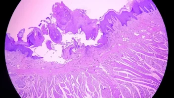 Premalignant oral lesions