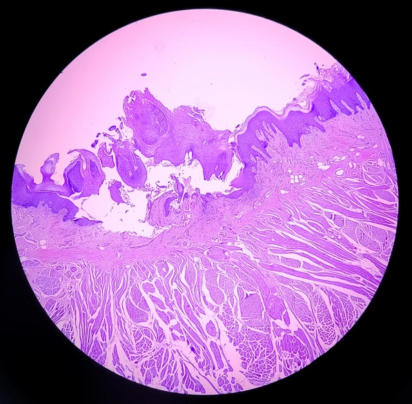 Premalignant oral lesions