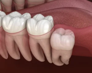 Removal of Third Molars