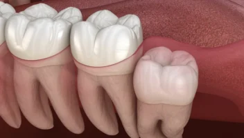 Removal of Third Molars
