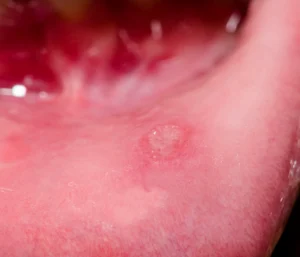 Subepithelial vesiculobullous lesions