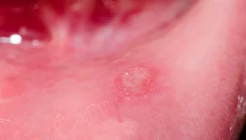 Subepithelial vesiculobullous lesions