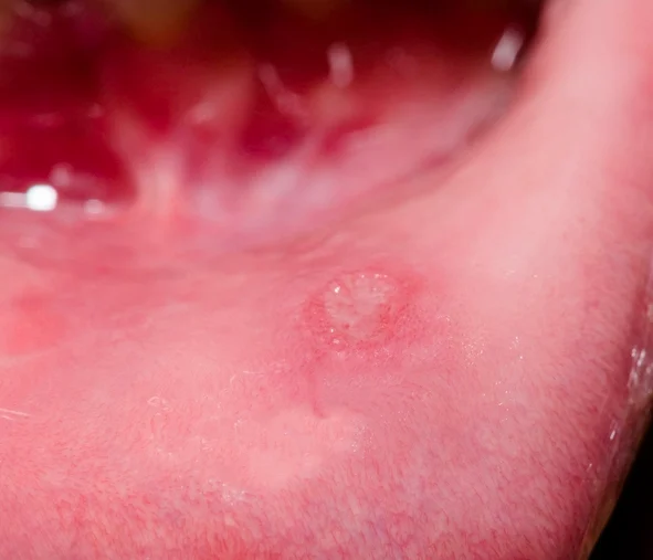 Subepithelial vesiculobullous lesions