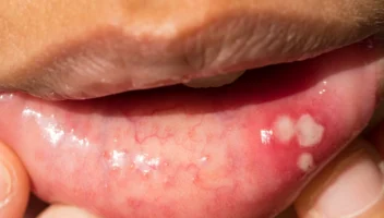 White patches in the mouth