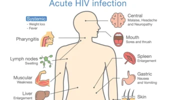 HIV and AIDS