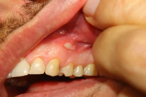 Oral Ulcers