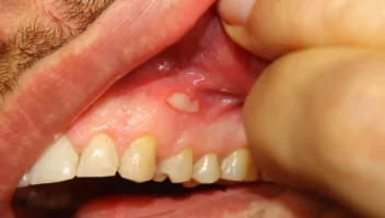 Oral Ulcers