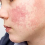 Oral manifestations of skin disease