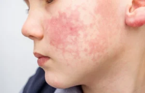 Oral manifestations of skin disease