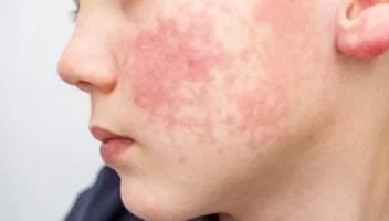 Oral manifestations of skin disease
