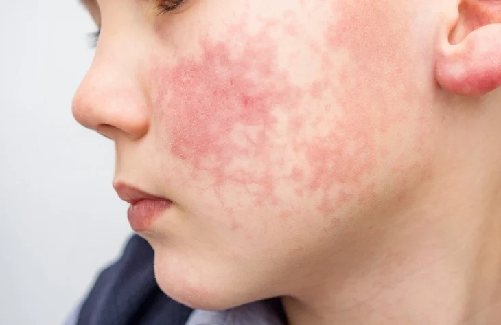 Oral manifestations of skin disease
